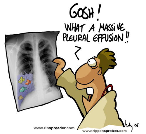 Pleural effusion